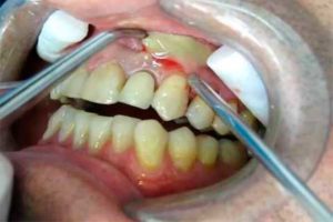 dentaltvweb_absceso_periodontal