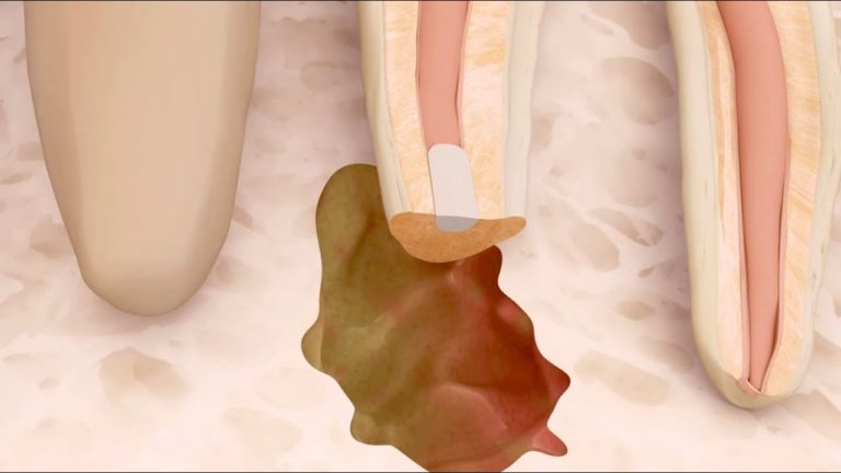 Cirugia Endodontica- Apicectomia