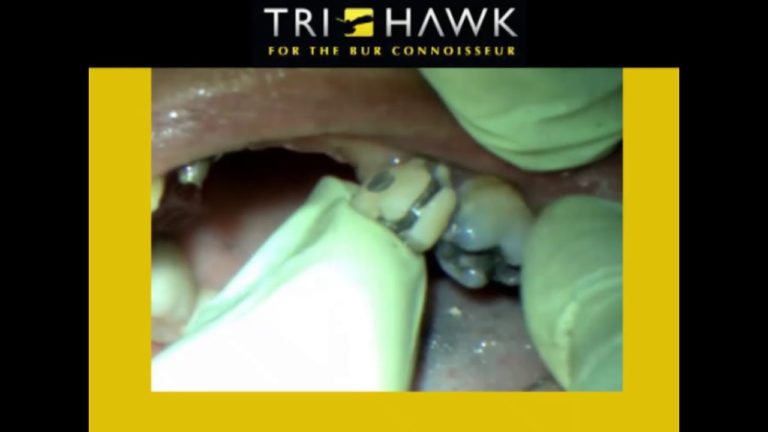 Como bajar una corona de porcelana sobre metal muy facilmente