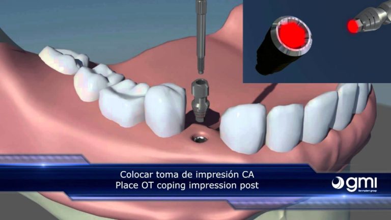 Toma de impresion de implante dental a cubeta abierta