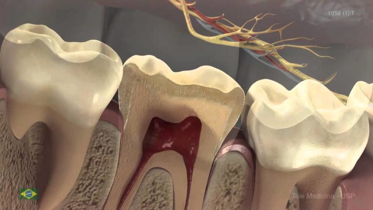 Formacion de lesiones de caries en superfície oclusal y estadios de severidad