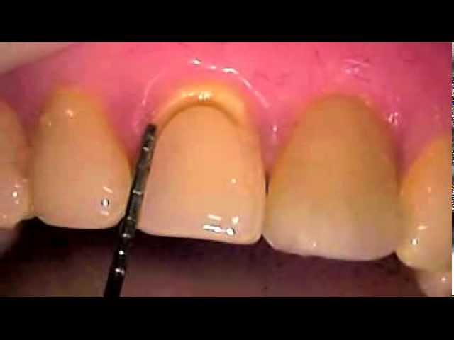 Protocolo de Preparacion y restauracion de Carillas Dentales directas- Paso Paso