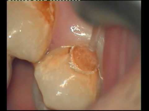 Remocion de caries con Laser