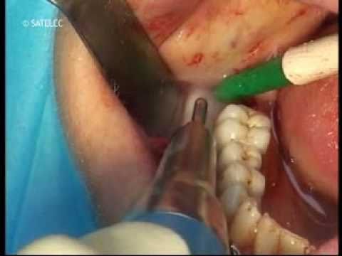 Extirpacion de hueso de mandíbula y autoinjerto (Piezotome Satelec)