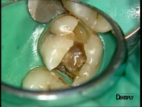 Restauracion mesio-Ocluso-Distal del diente 16 con composite