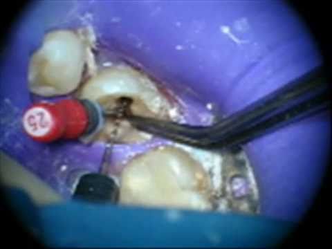 Remocion de una lima fracturada