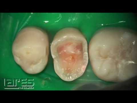 Preparacion de una corona con Laser