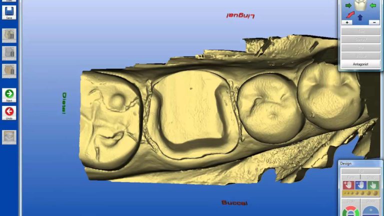Creacion de una Corona utilizando el Cerec con ceramica E-Max