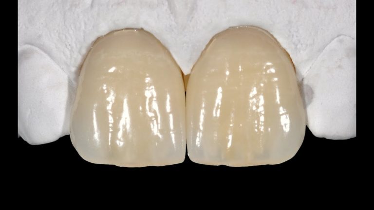 Realizacion de carillas de ceramica paso a paso.