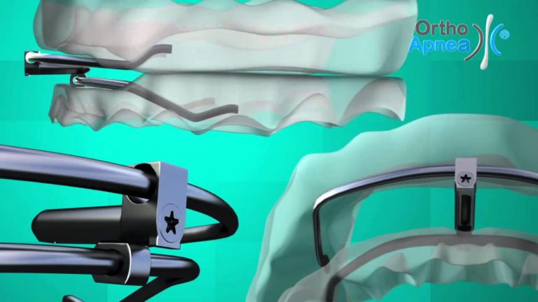 OrthoApnea