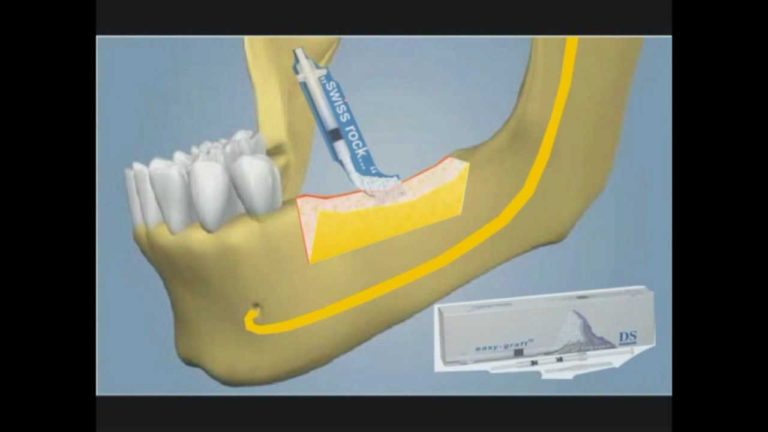 Colocacion de implantes dentales con osteotomia vertical sin colgajo para Piezotome I