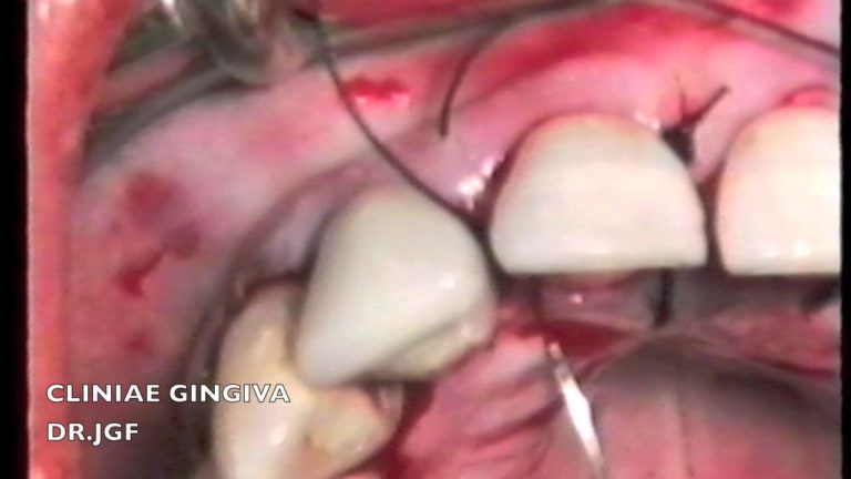 SUTURAS EN PERIODONCIA.