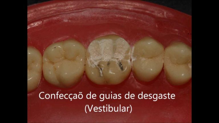 Preparacion para incrustacion (onlay) ceramica paso a paso