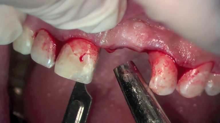 Aumento de reborde alveolar – CIRUGIA PERIODONTAL