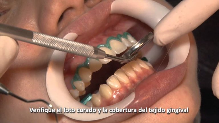 Blanqueamiento dental de dientes Vitales (Paso a Paso) – Whiteness HP BLUE de FGM