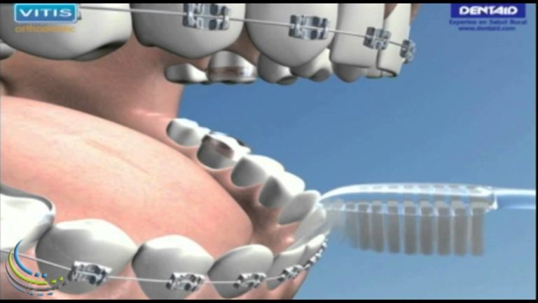 Tecnica de higiene bucal para ortodoncia dental
