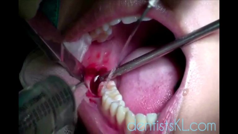 Extraccion de un 3er. molar impactado