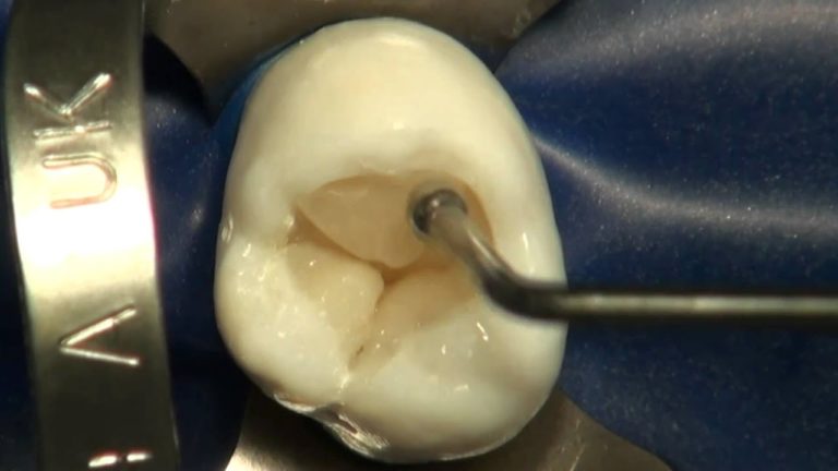 Composite Clase / Class I Molar Superior-Paso a Paso