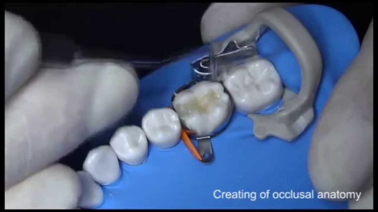 Restauracion dental Clase 2 en modelo con Sonic FIll