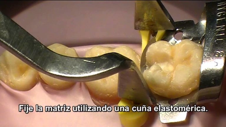 Biteperf: Restauracion Clase II