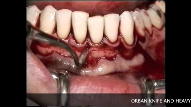 Cirugia y periodoncia. Tecnica de colgajo de reposicion apical