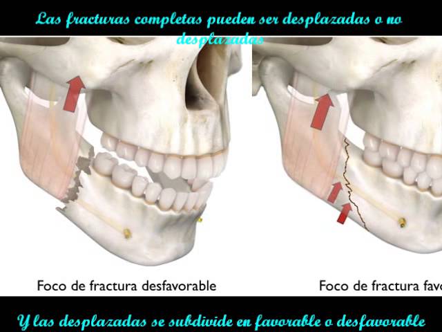 Fracturas mandibulares