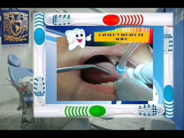 Selladores de fosas y fisuras dentales