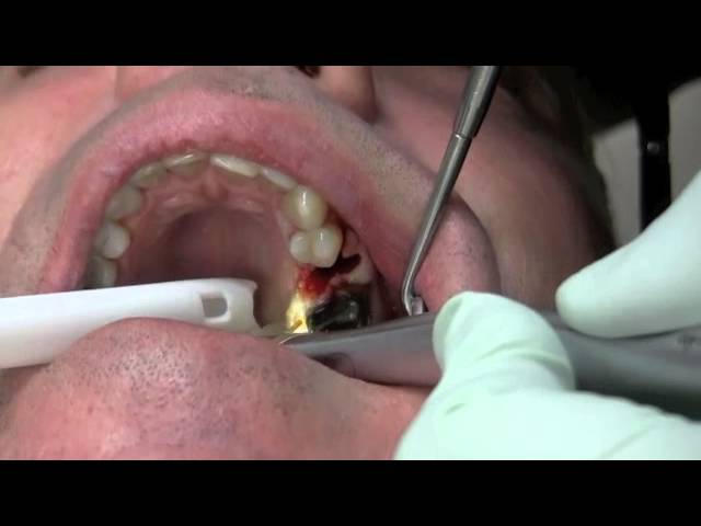 Extraccion con forceps dentales Physics mas Laser