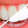 blanqueamiento dental