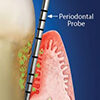 bolsa periodontal icono dentaltvweb