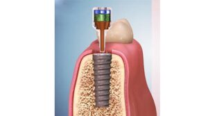 dentaltvweb_implante_dental_electromagnetico