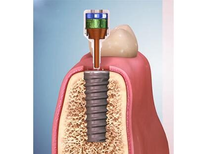dentaltvweb_implante_dental_electromagnetico