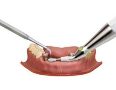 dentaltvweb_localizador_de_implantes