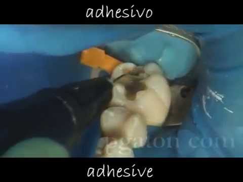 Reconstruccion estetica de un molar y remocion de amalgama