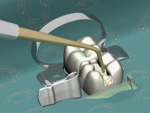 Como restaurar la caja proximal de la pieza dental-Animacion 3D