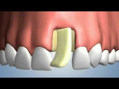 Injerto oseo dental bloque anterior