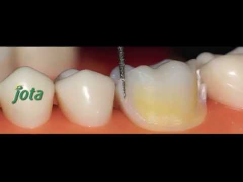 Preparacion en dientes posteriores con chamfer