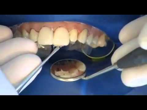 Componeer, carillas dentales prefabricadas