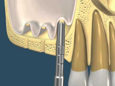 Implantes dentales: Levantamiento de Seno Maxilar com la Tecnica de Summer