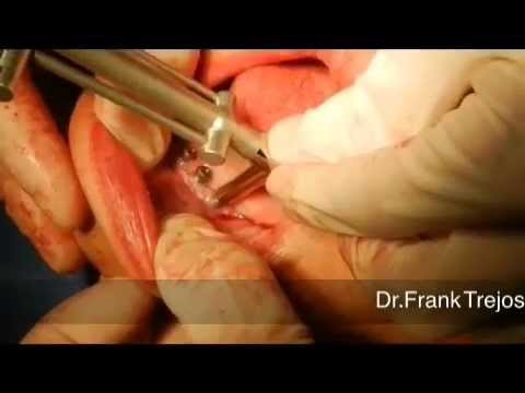 Remocion de implantes dentales con Neo fixture remover kit