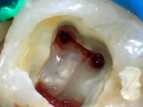 Revascularizacion Pulpar