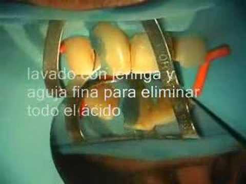 Tecnica de colocacion de postes