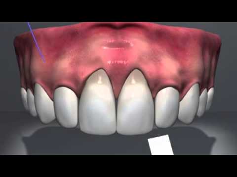 Tratamiento de recesiones multiples mediante técnica de tunelización con matriz dérmica acelular.