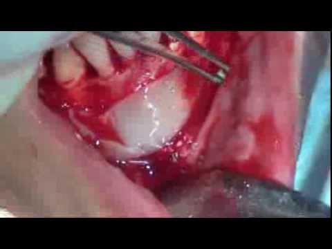 INJERTO OSEO AUTOLOGO DE MENTON