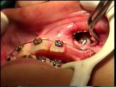 Traccion Ortodontica de un Canino Retenido
