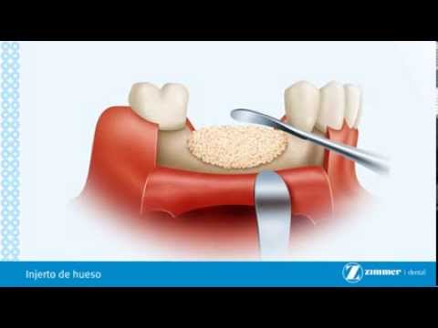 Injerto de hueso para implantes dentales