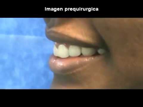 CIRUGIA DE ALARGAMIENTO CORONAL