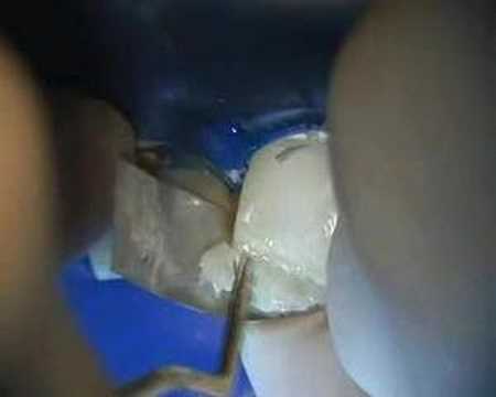 Protocolo de restauracion de una Clase IV en una pieza dental