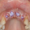 icono adhesivo de cicatrizacion para tejidos bucales de Glustitch dentaltvweb