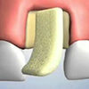 injerto oseo sintetico icono dentaltvweb